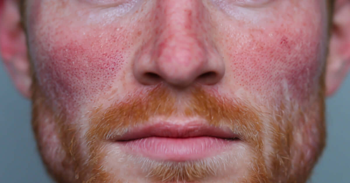 Postbiotic Skincare Benefits for Sensitive Skin